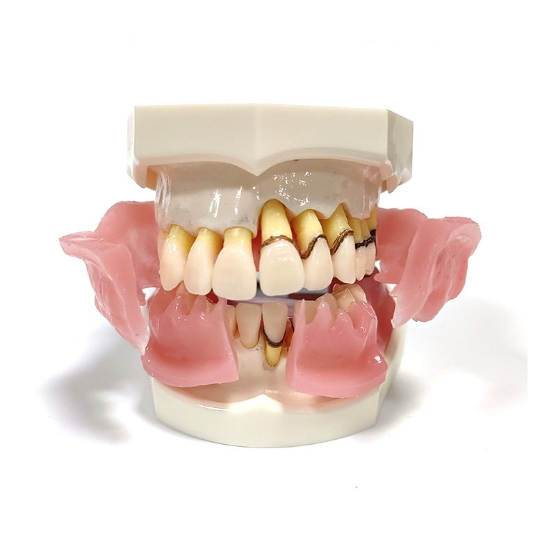 UM-4024-2 Periodontal Model