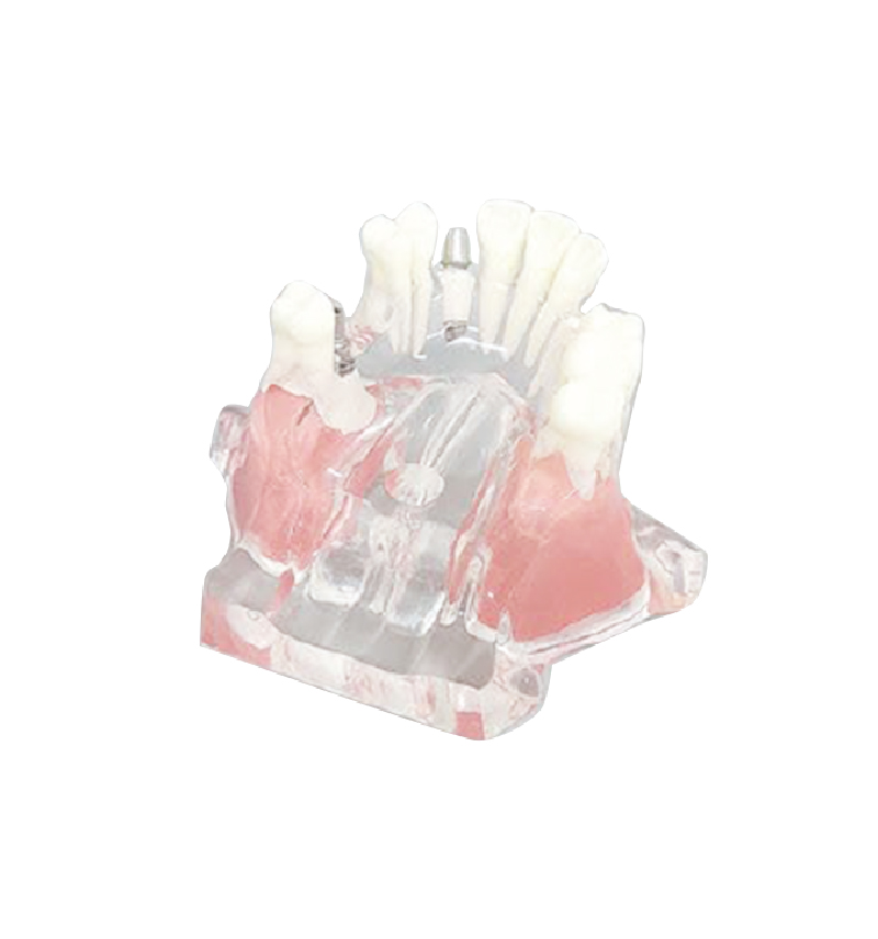 UM-2015-3 Implant Model - upper