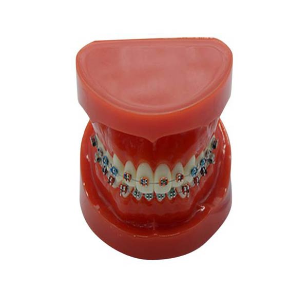 UM-B16 Study Model With Fixed Braces On Teeth