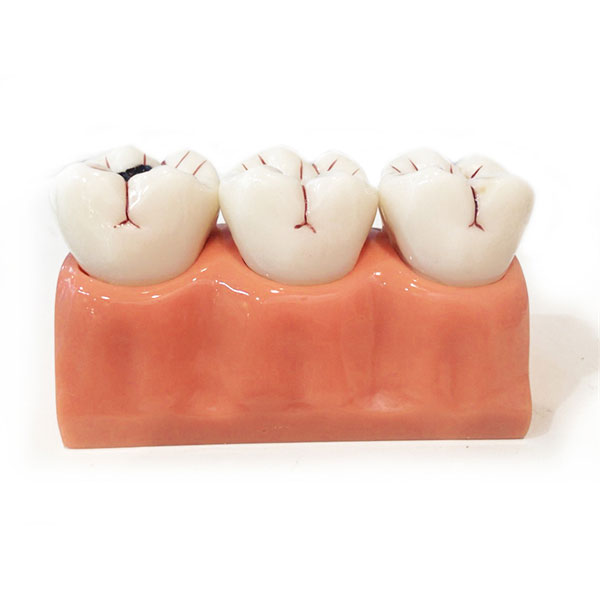 UM-L10 4 Times Sized Caries Disassembling Model
