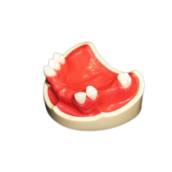 The Details of Um-ht2 Teeth Missing with Silicone Rubber