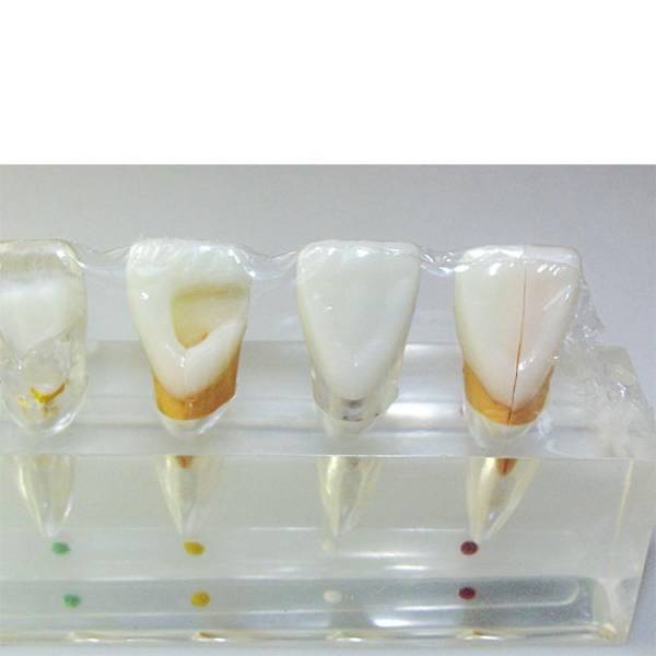 Um-l3b Clinical Model of Tooth and Dental Pulp Disease