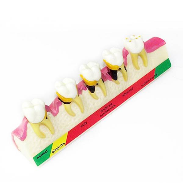 Um-e9 Periodontal Diseases Classification Model