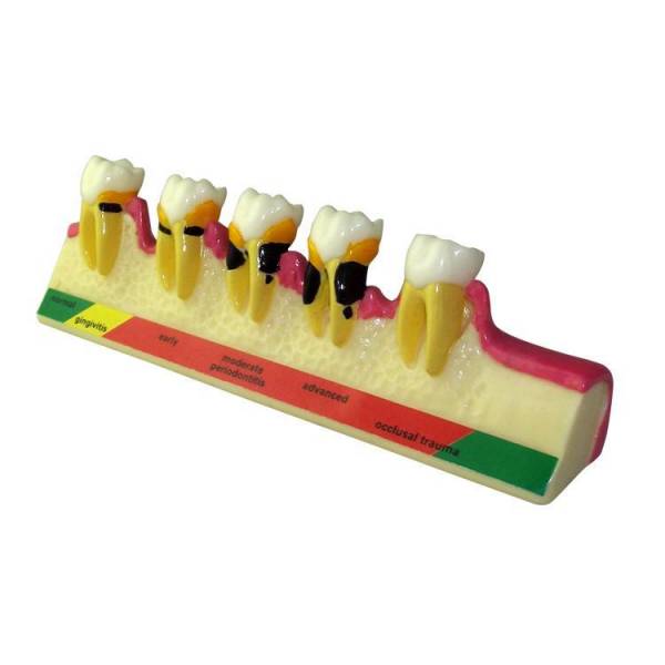 Um-e9 Periodontal Diseases Classification Model