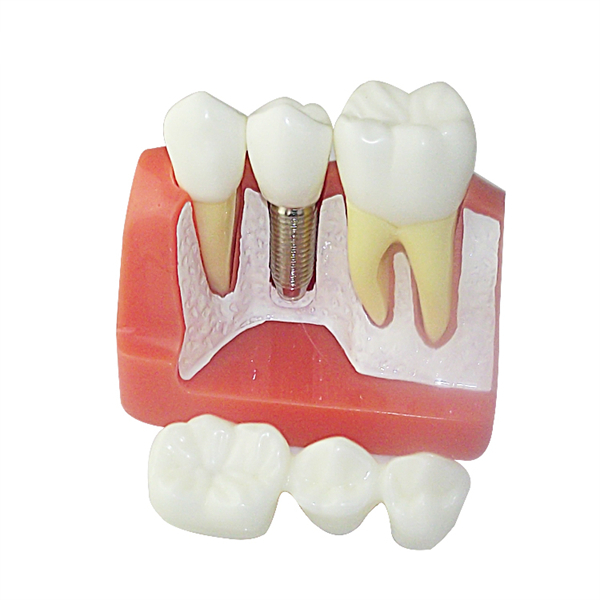 Um-z1 Implant Model for Doctor-patient Communication Use