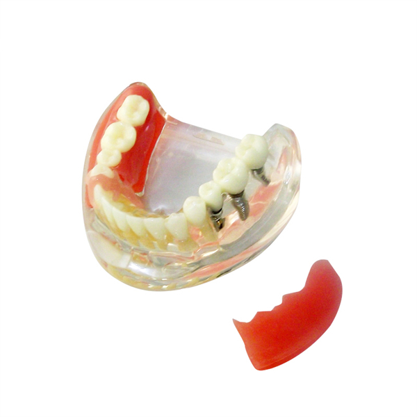 Um-z11 Educational Model for Implant Denture