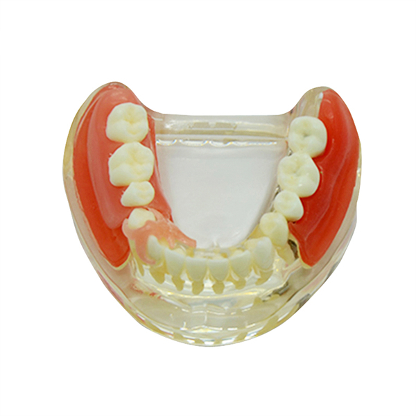 Um-z11 Educational Model for Implant Denture