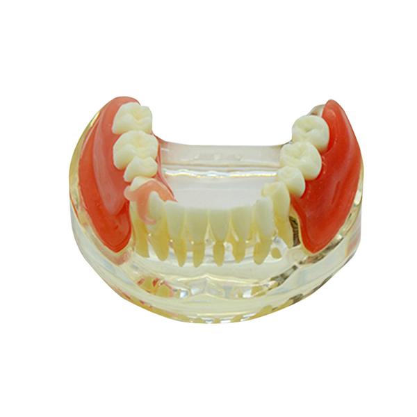 Um-z11 Educational Model for Implant Denture