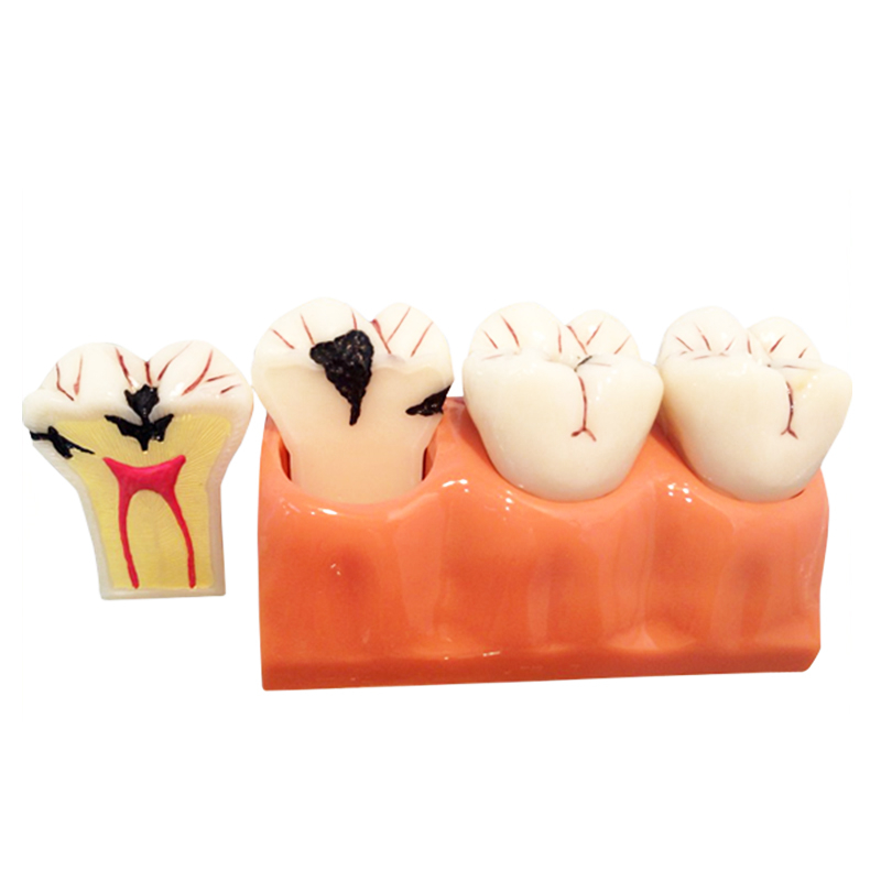 UM-L10 4 Times Sized Caries Disassembling Model